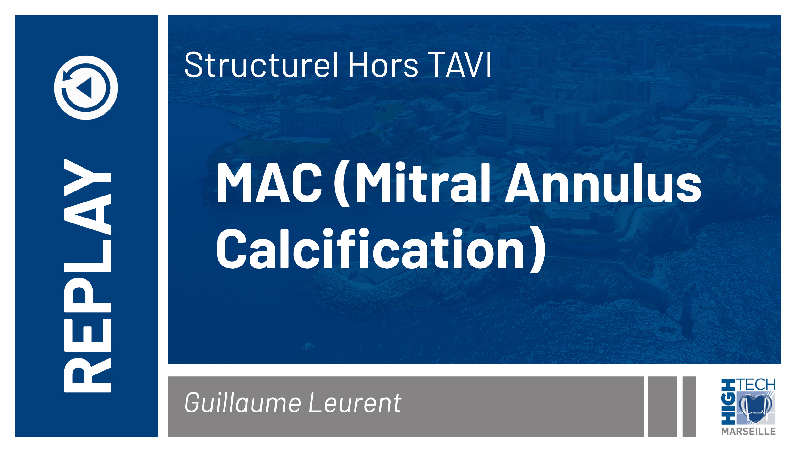 MAC (Mitral Annulus Calcification) – Guillaume Leurent