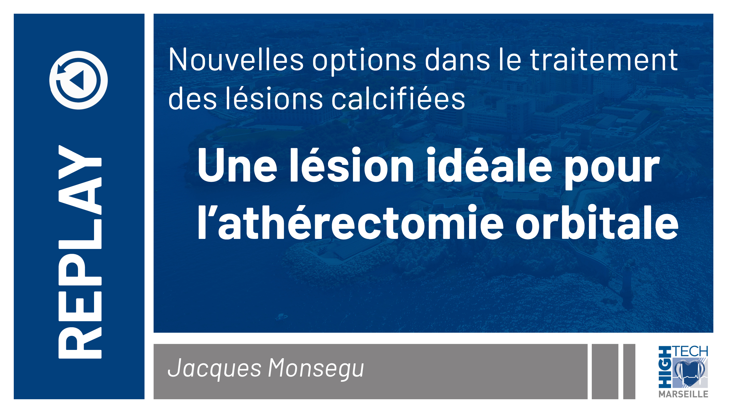 Une lésion idéale pour l’athérectomie orbitale – Jacques Monsegu