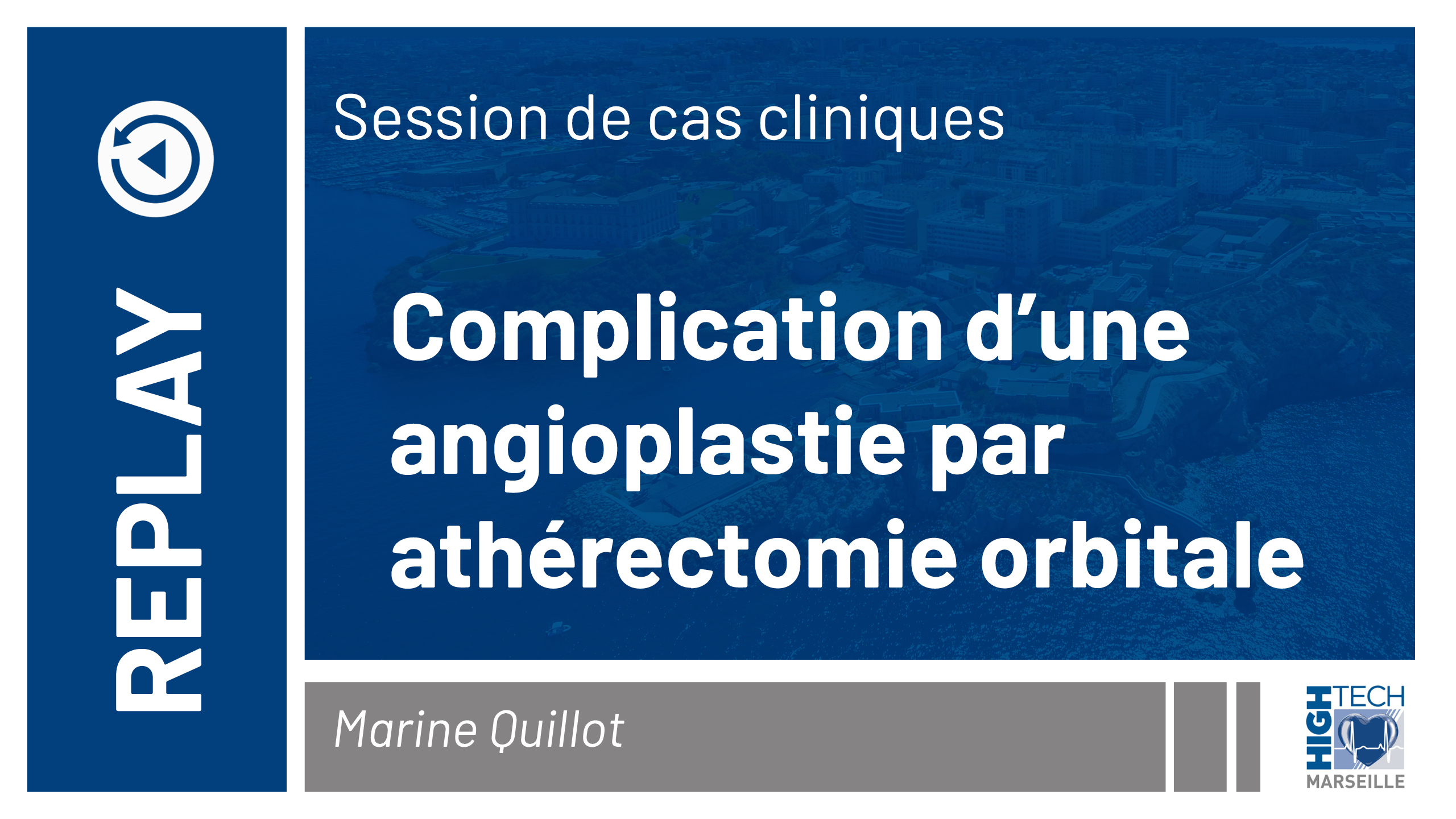 Complication d’une angioplastie par athérectomie orbitale – Marine Quillot