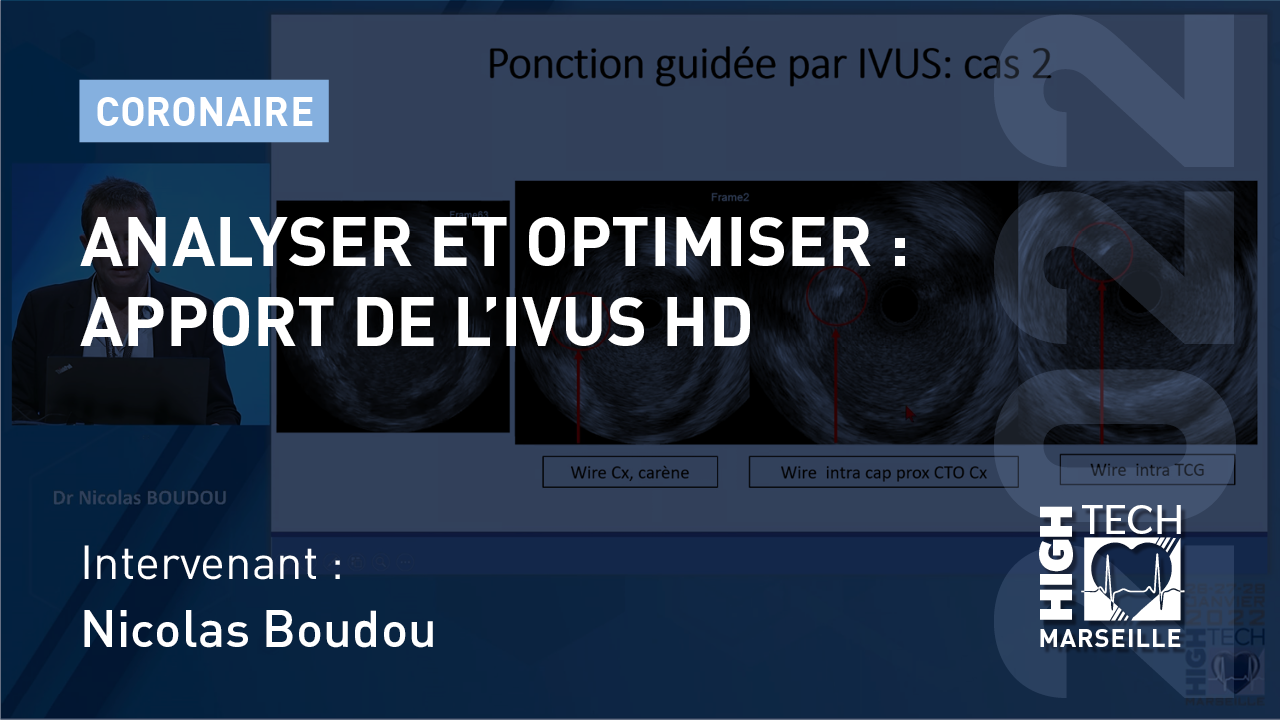 Analyser et optimiser : apport de l’IVUS HD – Nicolas Boudou