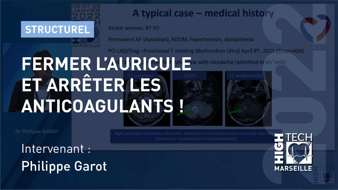 Fermer l’auricule et arrêter les anticoagulants ! Philippe Garot