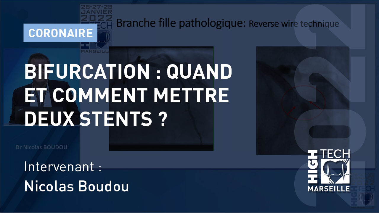 Bifurcation : quand et comment mettre deux stents ? Nicolas Boudou