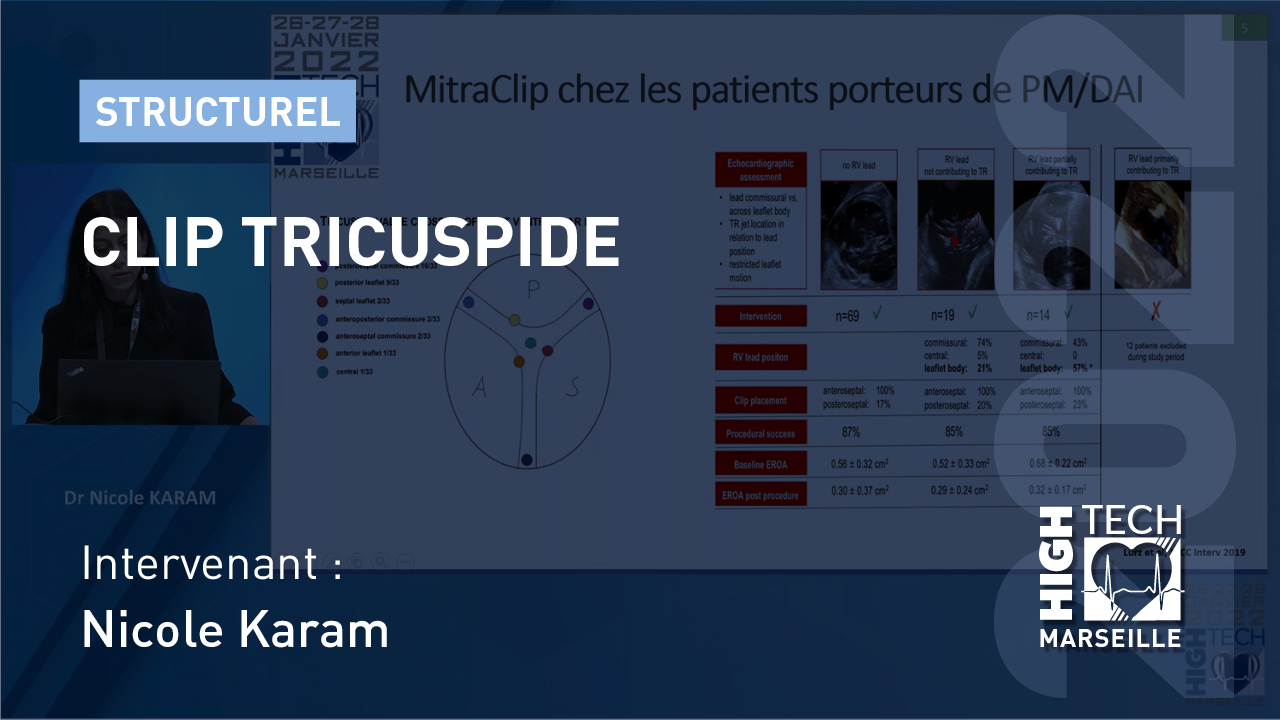 Clip tricuspide – Nicole Karam