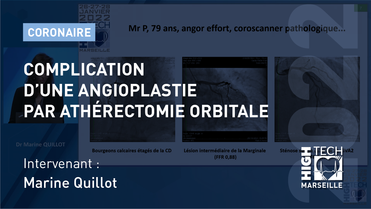 Complication d’une angioplastie par athérectomie orbitale – Marine Quillot