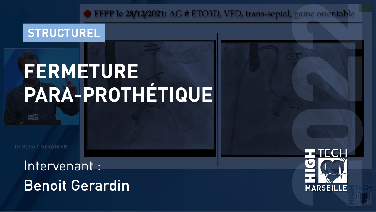 Fermeture para-prothétique – Benoit Gerardin