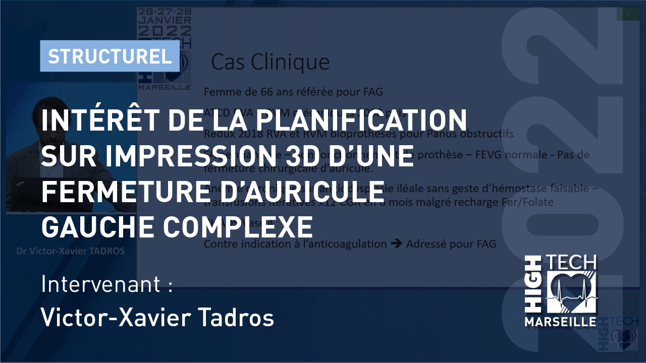 Intérêt de la planification sur impression 3D d’une fermeture d’auricule gauche complexe – Tadros