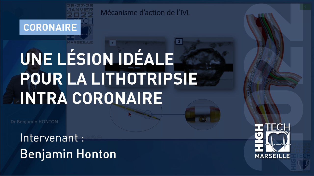 Une lésion idéale pour la Lithotripsie intra coronaire – Benjamin Honton