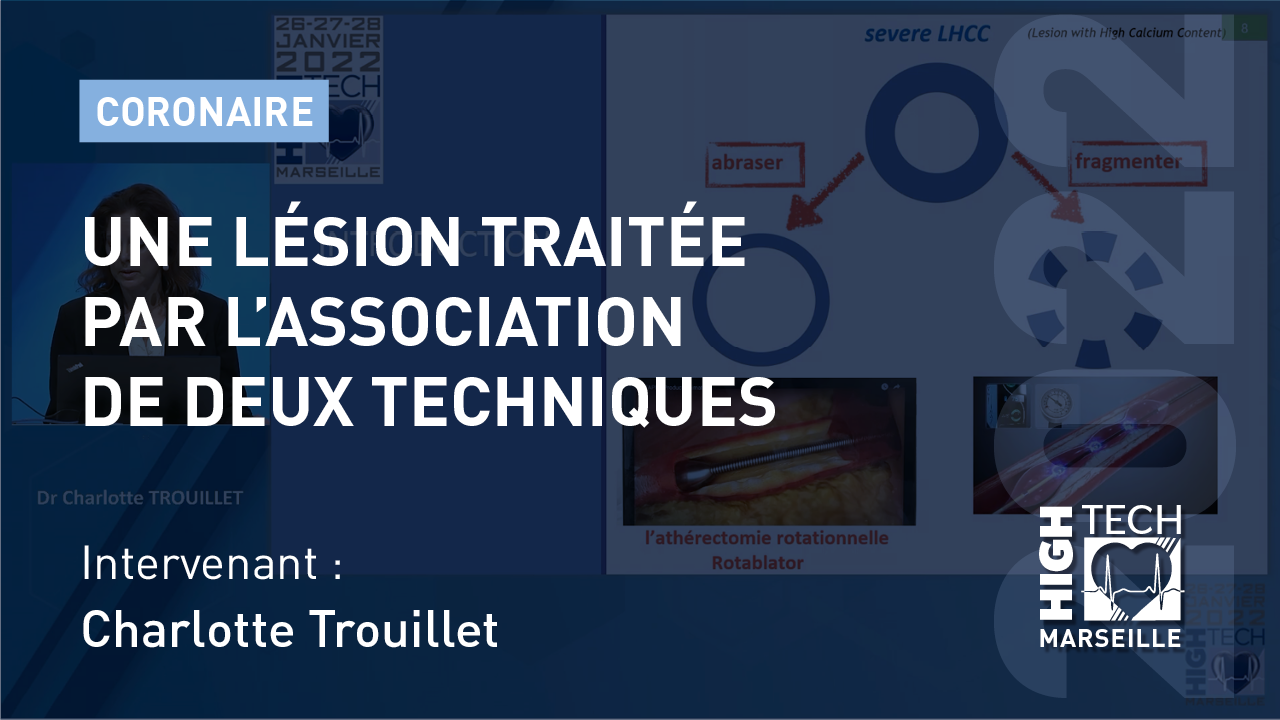 Une lésion traitée par l’association de deux techniques – Charlotte Trouillet