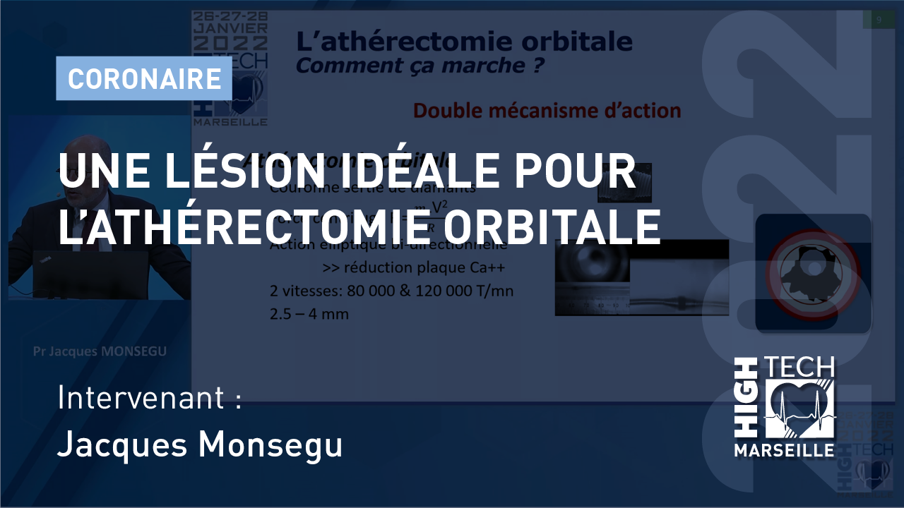 Une lésion idéale pour l’athérectomie orbitale – Jacques Monsegu