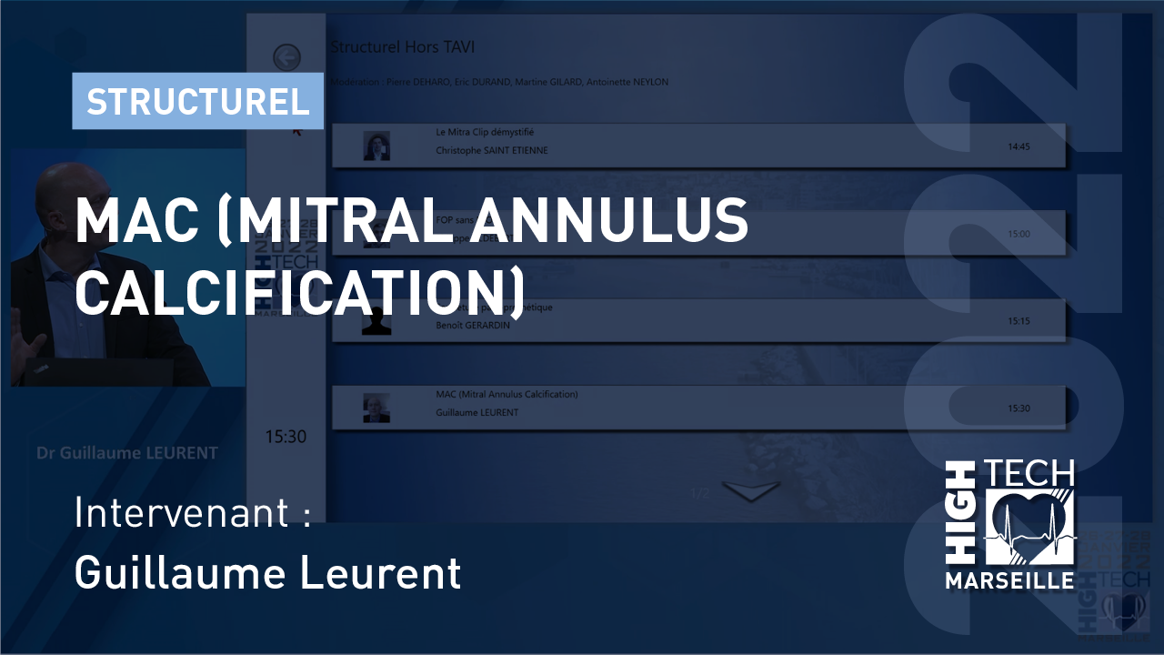 MAC (Mitral Annulus Calcification) – Guillaume Leurent