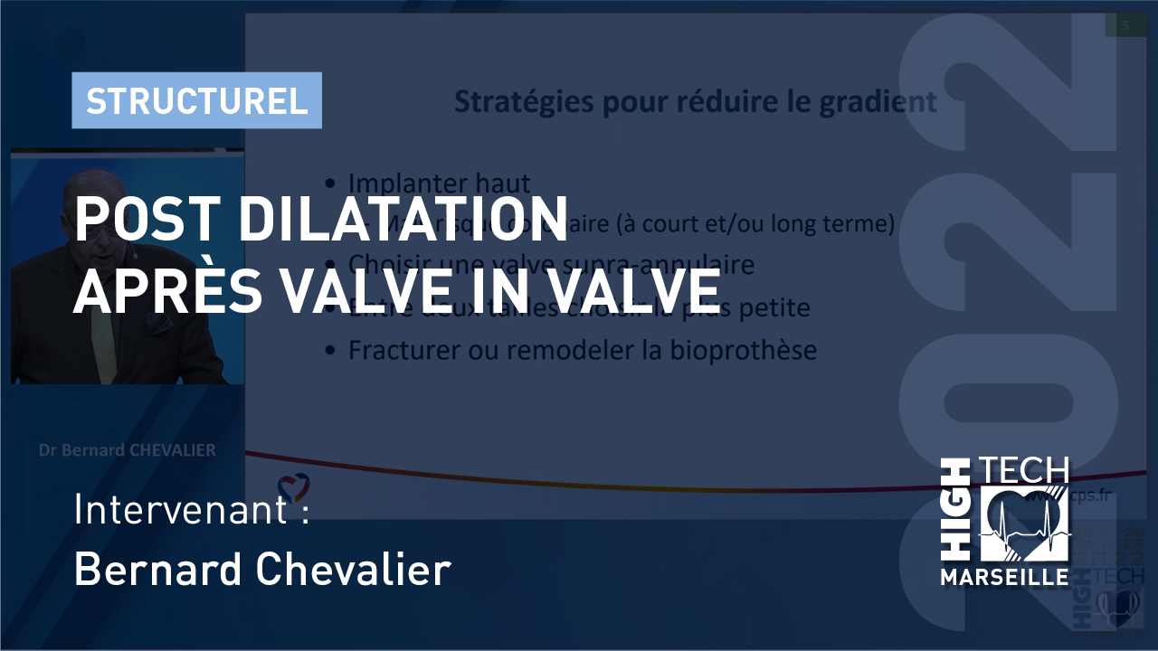 Post dilatation après valve in valve – Bernard Chevalier