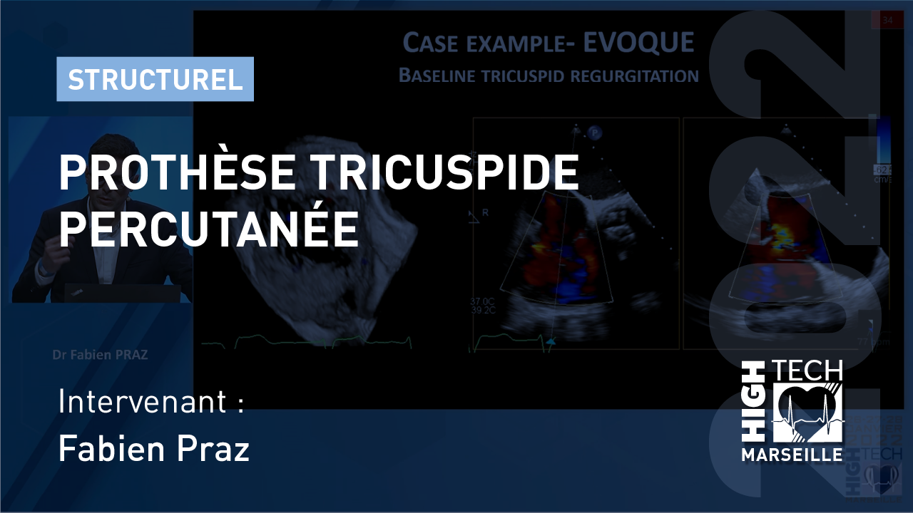 Prothèse tricuspide percutanée – Fabien Praz