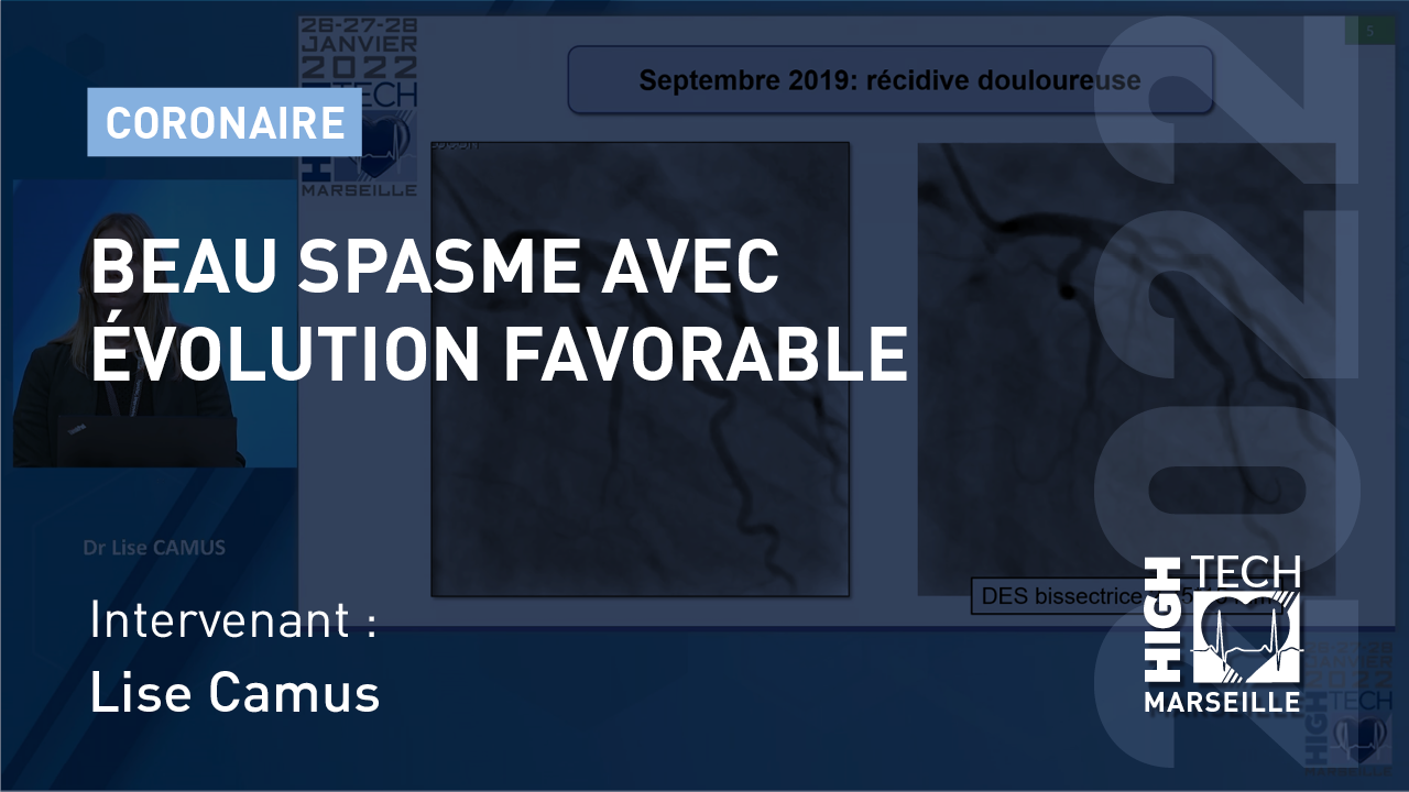 Beau spasme avec évolution favorable – Lise Camus