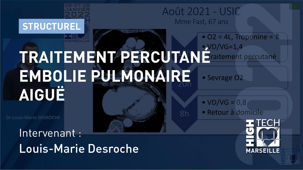 Traitement percutané embolie pulmonaire aiguë – Louis-Marie Desroche