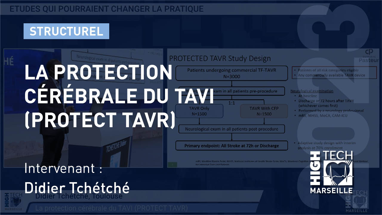 La protection cérébrale du TAVI (PROTECT TAVR) –  Didier Tchétché