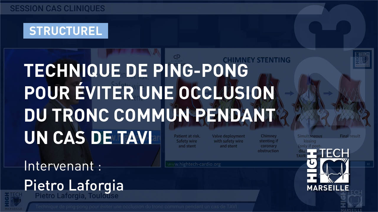 Technique de ping-pong pour éviter une occlusion du tronc commun pendant un TAVI – Pietro Laforgia