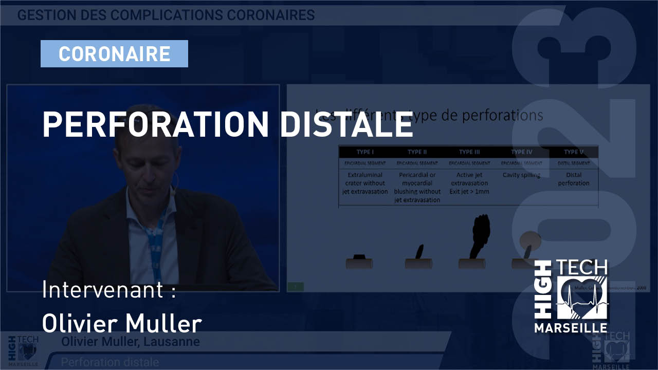 Perforation distale – Olivier Muller