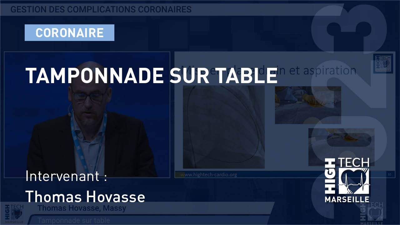 Tamponnade sur table – Thomas Hovasse