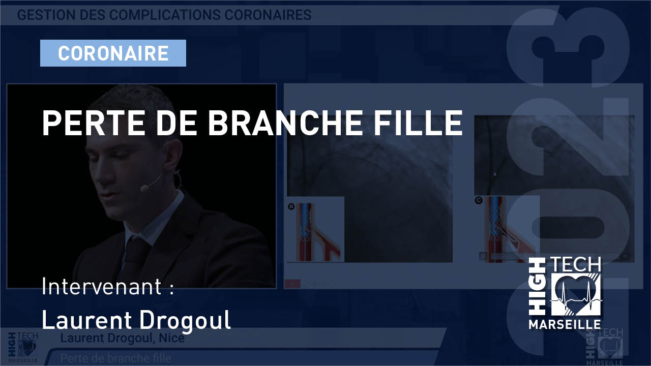 Perte de branche fille – Laurent Drogoul