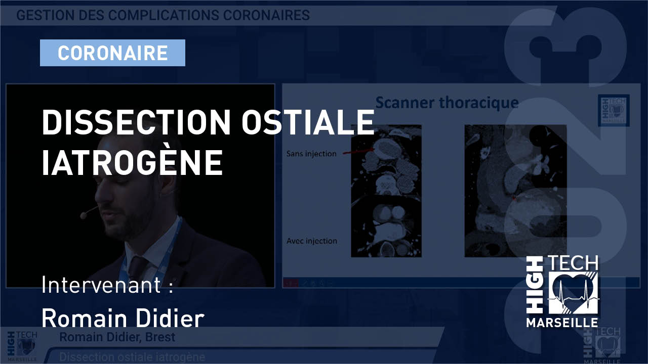 Dissection ostiale iatrogène – Romain Didier