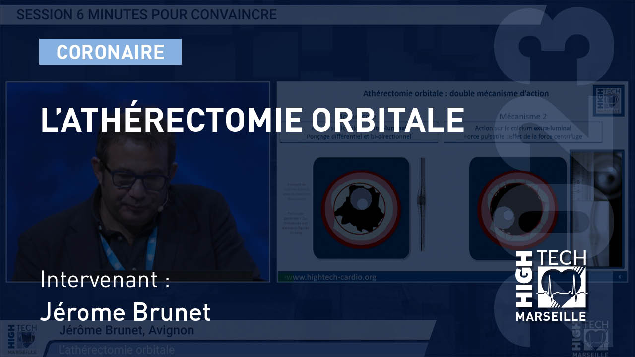 L’athérectomie orbitale – Jérôme Brunet