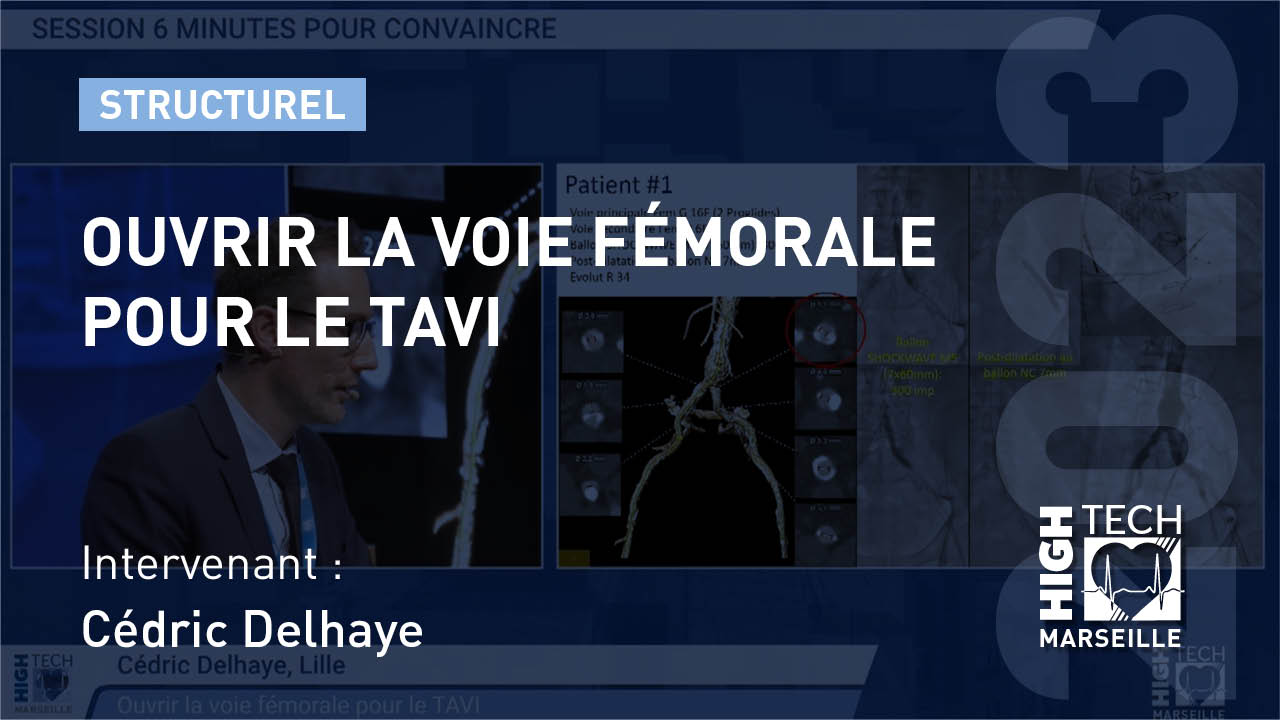 Ouvrir la voie fémorale pour le TAVI – Cédric Delhaye