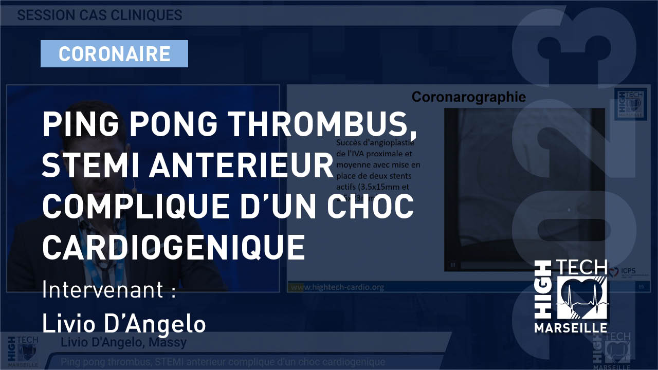 Ping pong thrombus, STEMI anterieur complique d’un choc cardiogenique –     Livio D’Angelo