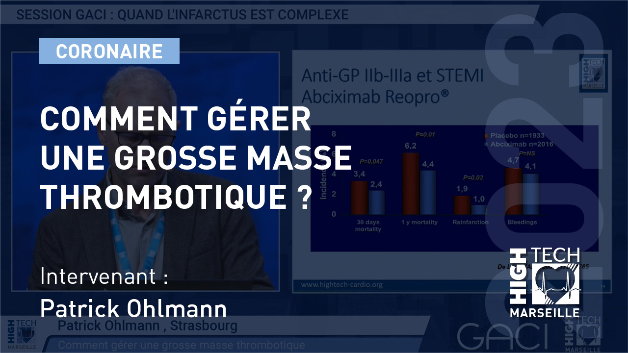 Comment gérer une grosse masse thrombotique ? – Patrick Ohlmann