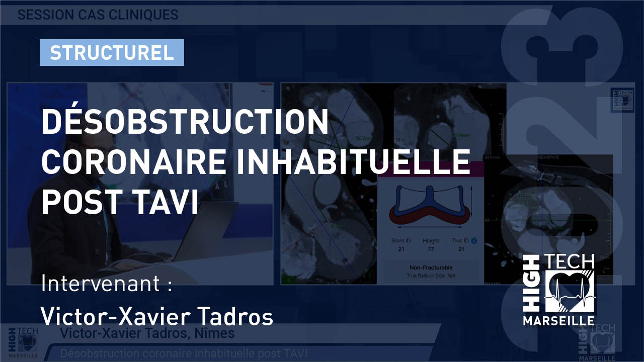 Désobstruction coronaire inhabituelle post TAVI –  Victor Xavier Tadros