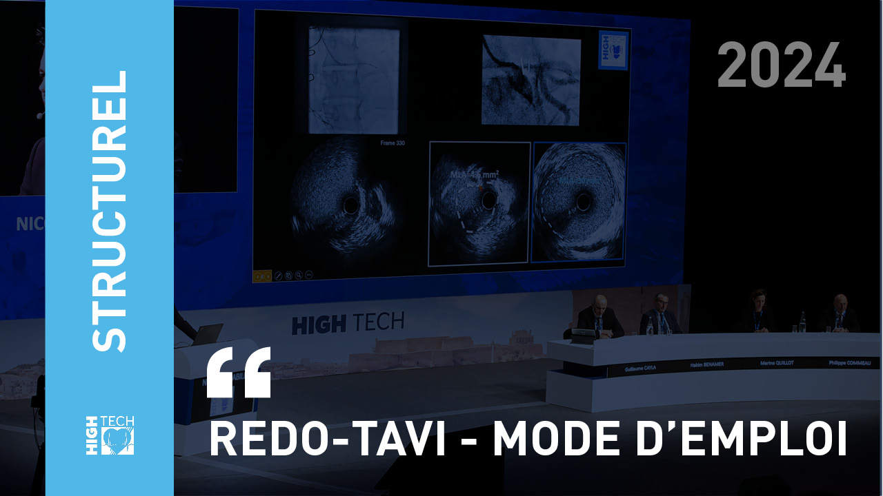 Redo-TAVI – mode d’emploi – Nicolas Dumonteil