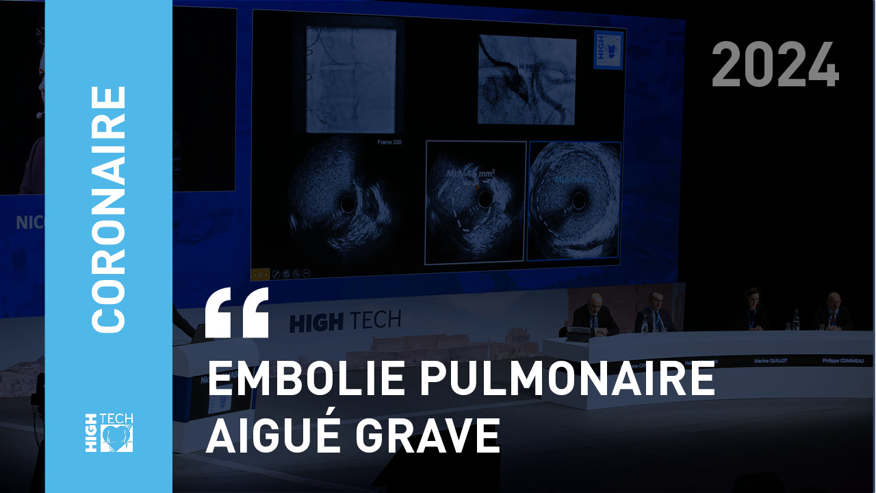 Embolie pulmonaire aiguë grave – Nicolas Meneveau