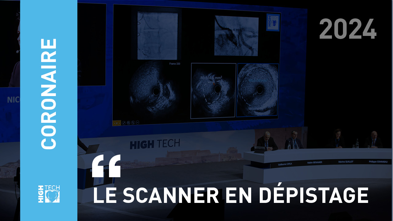 Le scanner en dépistage – Bernard Chevalier