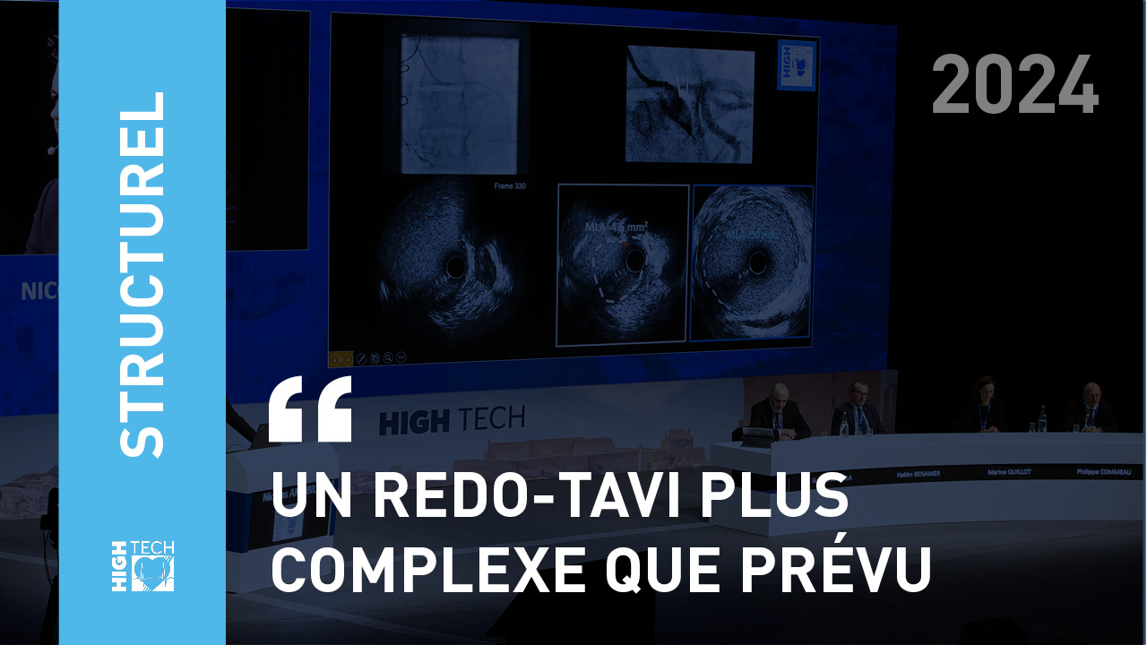 Un Redo-TAVI plus complexe que prévu – Jérémy Boyer