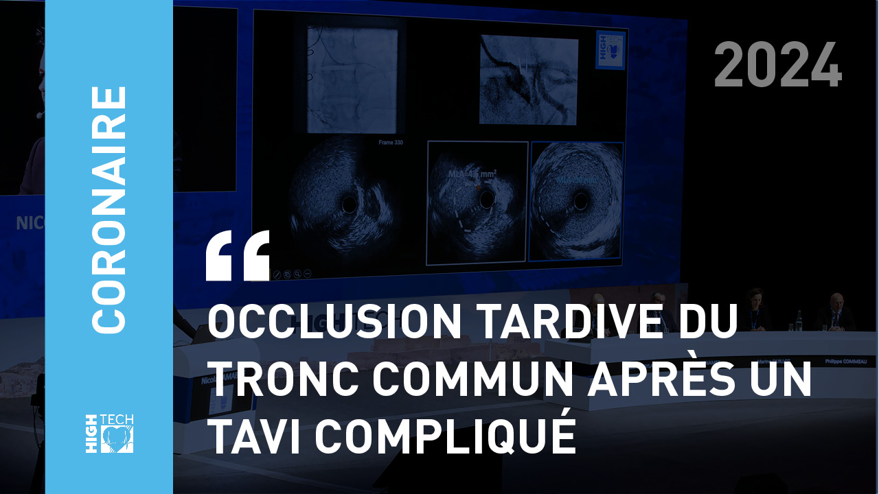 Occlusion tardive du tronc commun après un TAVI compliqué – Alessandro Beneduce