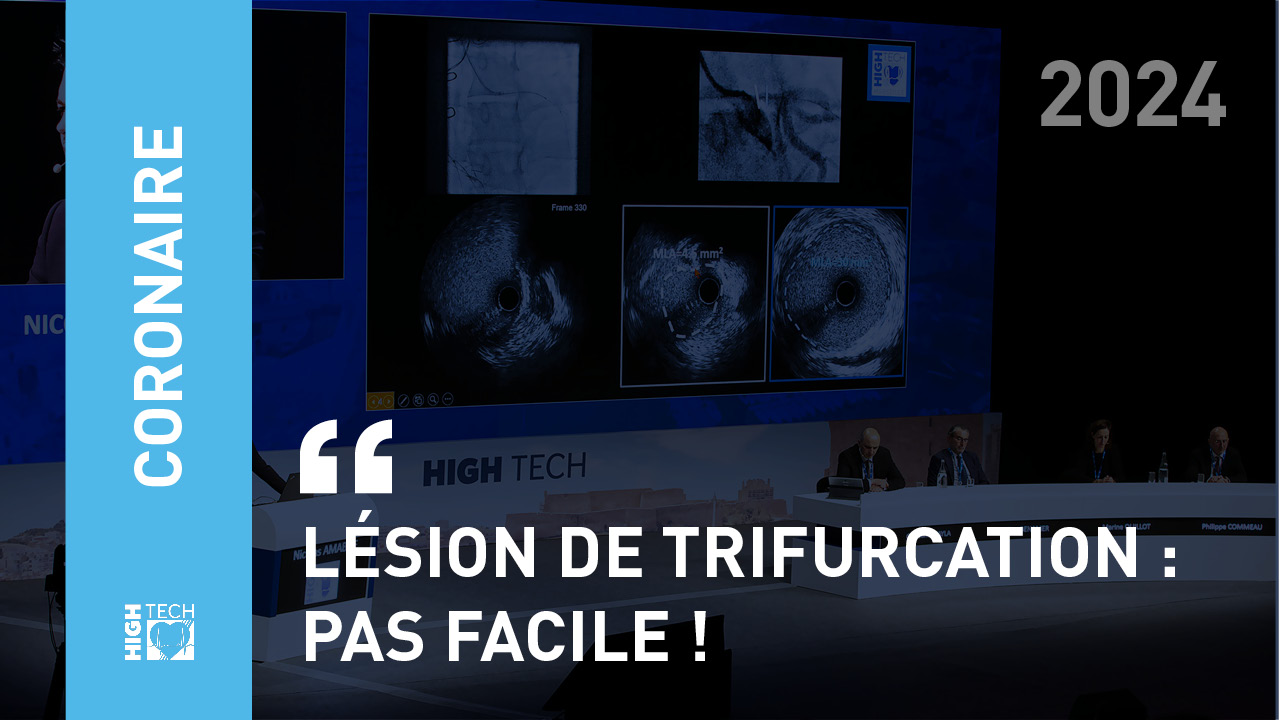 Lésion de Trifurcation : Pas Facile ! – Saida Bousafa