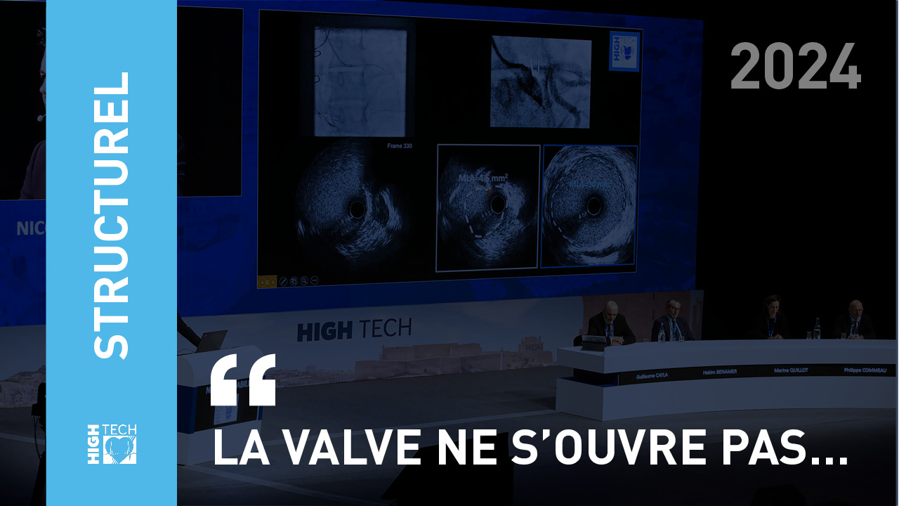 La valve ne s’ouvre pas… – Thibault Pamart