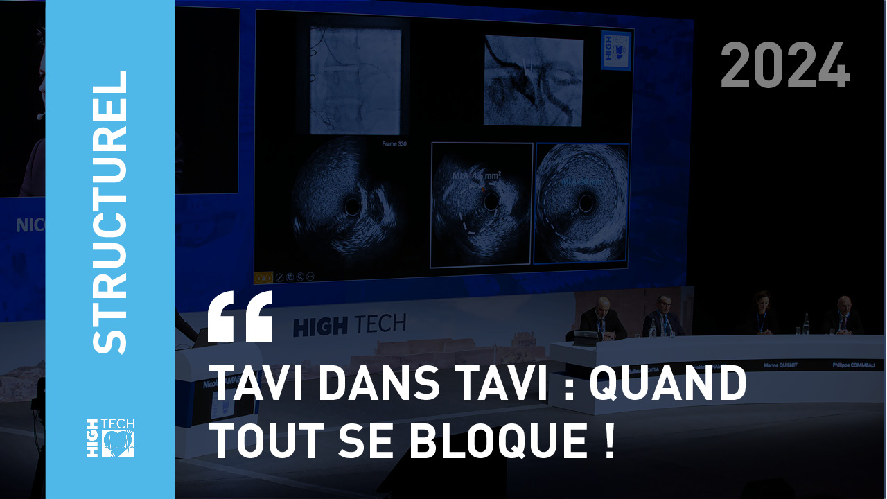 TAVI dans TAVI : quand tout se bloque ! – Romain Didier